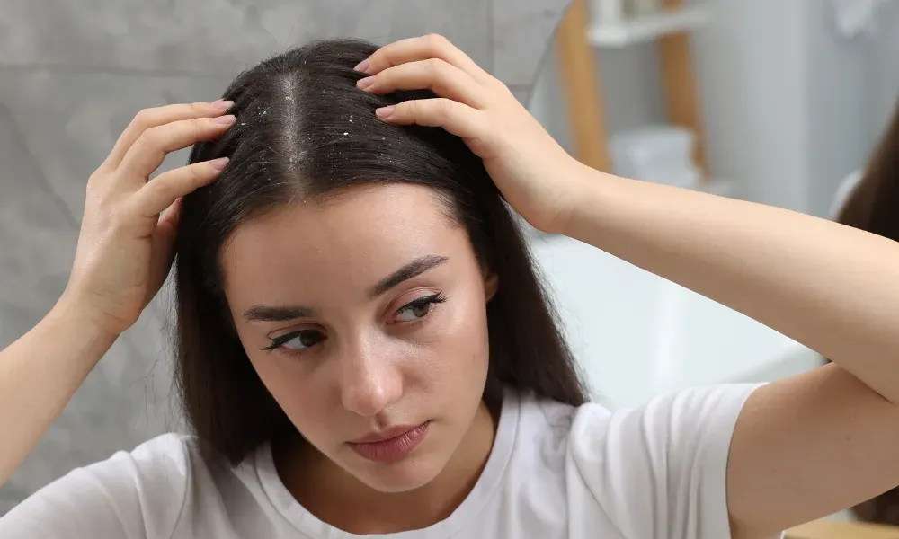 Dandruff