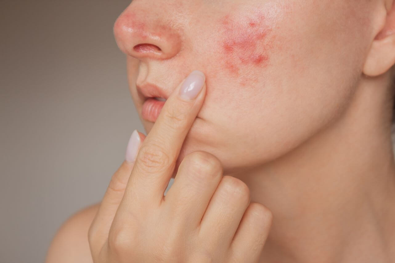 Acne
