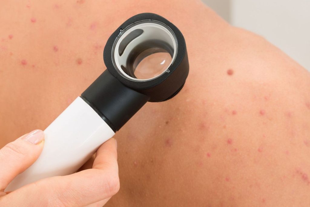 Skin Cancer