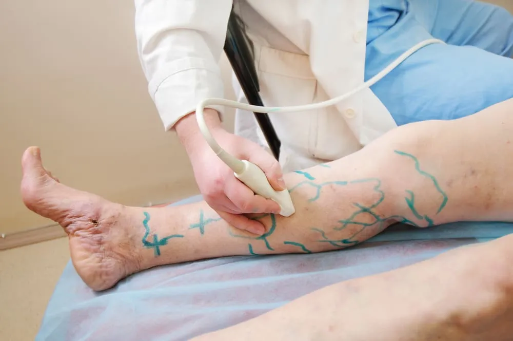 Sclerotherapy