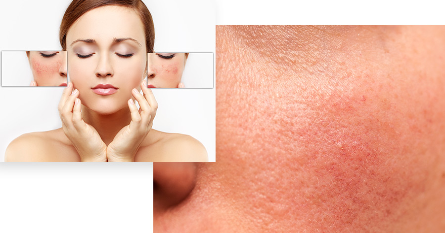 Chemical Peels