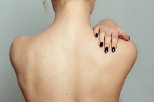 Lipoma