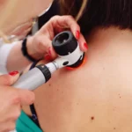 Skin Cancer