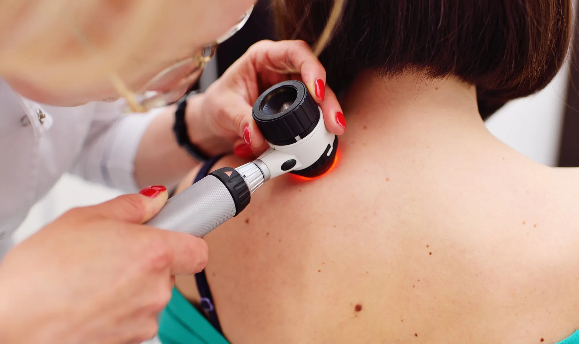 Skin Cancer